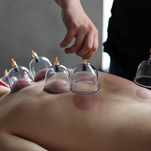 cupping-Enhanced-Family-Physio-Dalton-GA