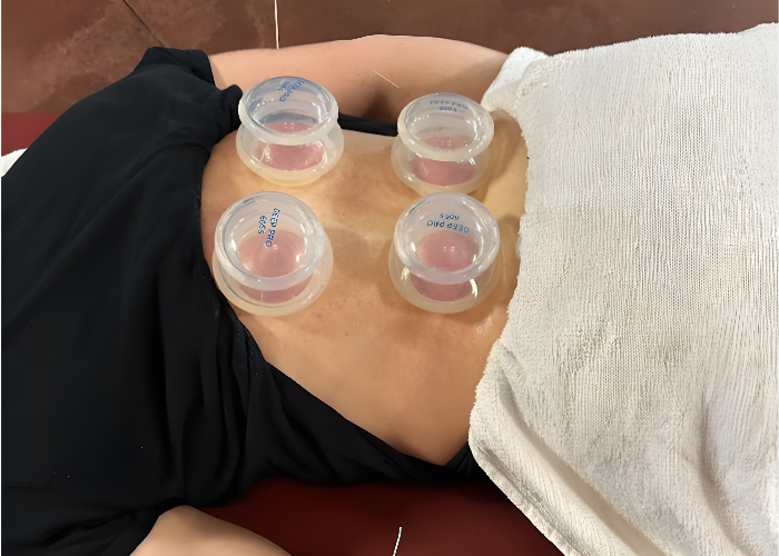cupping-enhanced-family-physio-dalton-ga