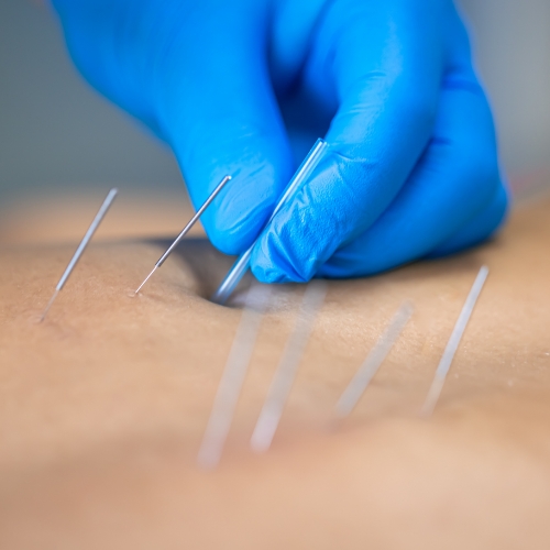 dry-needling-Enhanced-Family-Physio-Dalton-GA